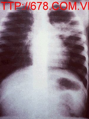 Các biến chứng phế quản của bệnh lao phổi